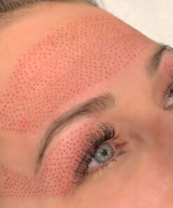 Plasma Skin Tightening Training | One-on-one